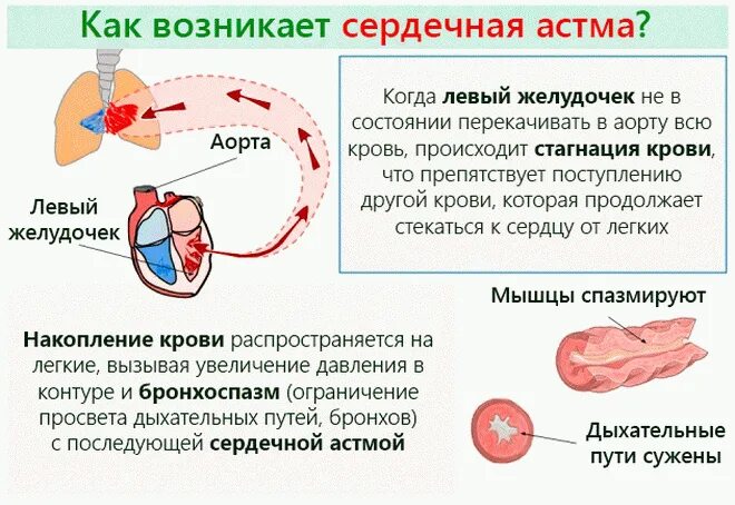 Сердечная астма механизм развития. Механизм возникновения сердечной астмы. Сердечная астма патогенез. Кардиальная астма.