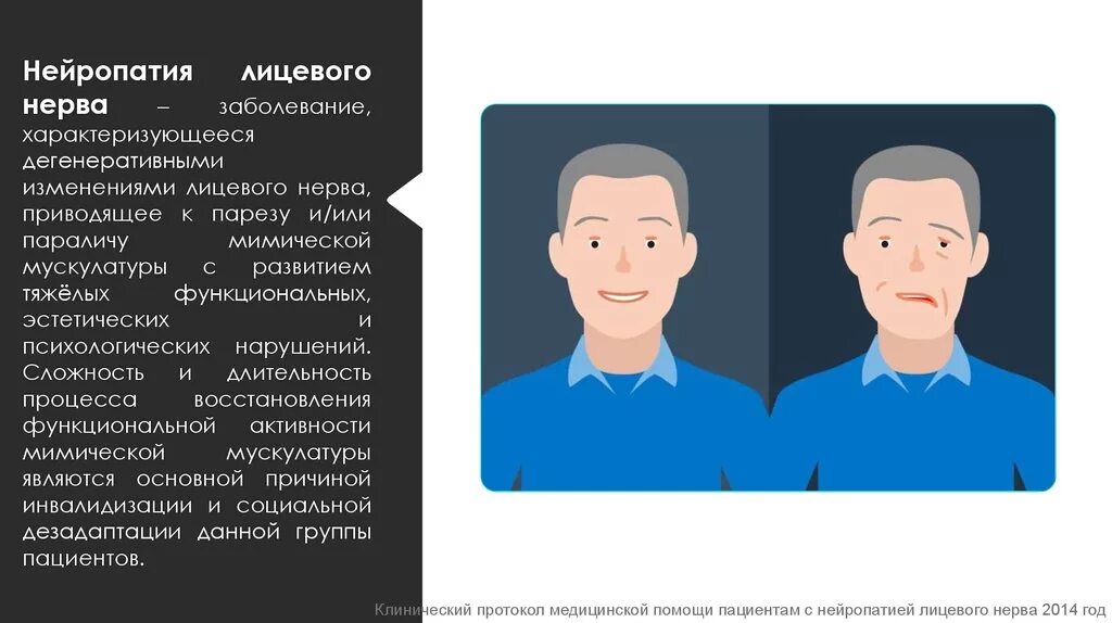 Неврит лицевого нерва рекомендации. Нейропатия лицевого нерва. Нейропапатия лицевого нерва. Нейропатия лицевого нерва нерва. Лицевой неврит.