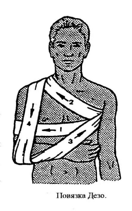 Техника наложения повязки на плечо