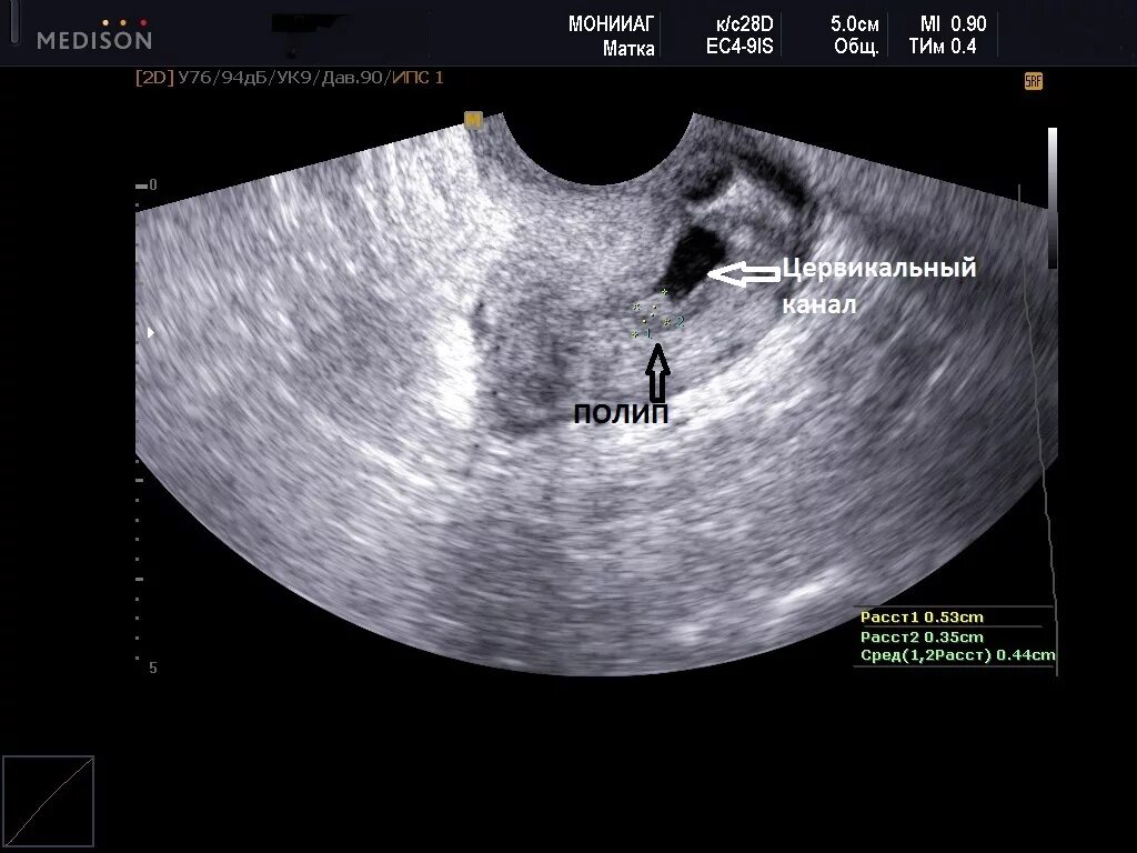Полип цервикального канала на УЗИ. Полип цервикального канала ухи. Полип эндометрия и цервикального канала. Эндоцервикальный полип. На узи видно месячные