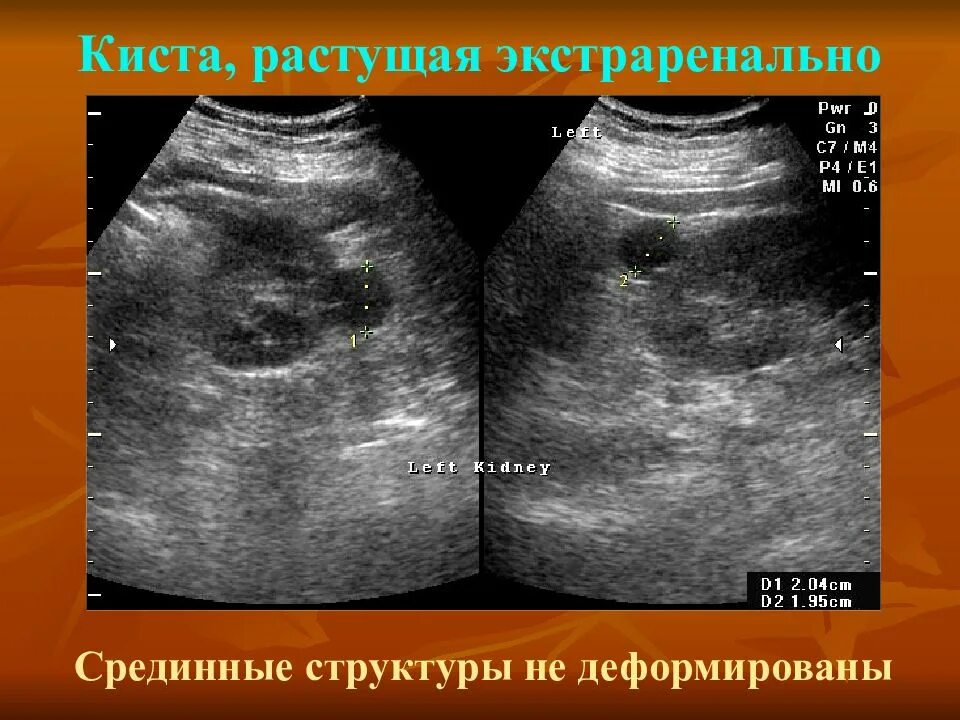 Киста в почке лечение у взрослых женщин. Экстраренальная киста.