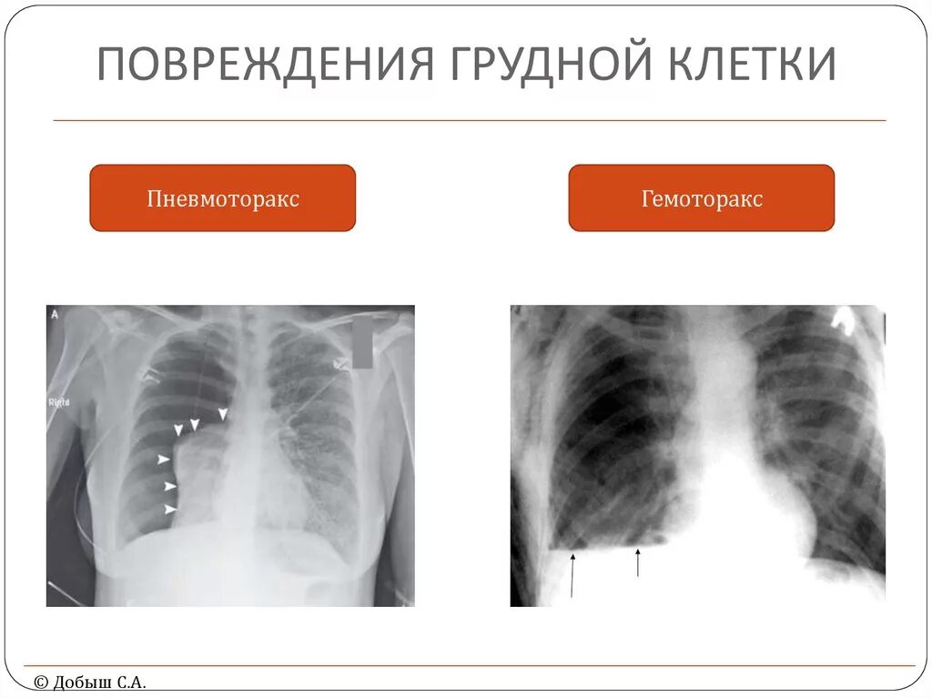 Повреждение грудной клетк. Перелом ребер гемоторакс. Классификация закрытой травмы грудной клетки. Травмы грудной клетки рентген.