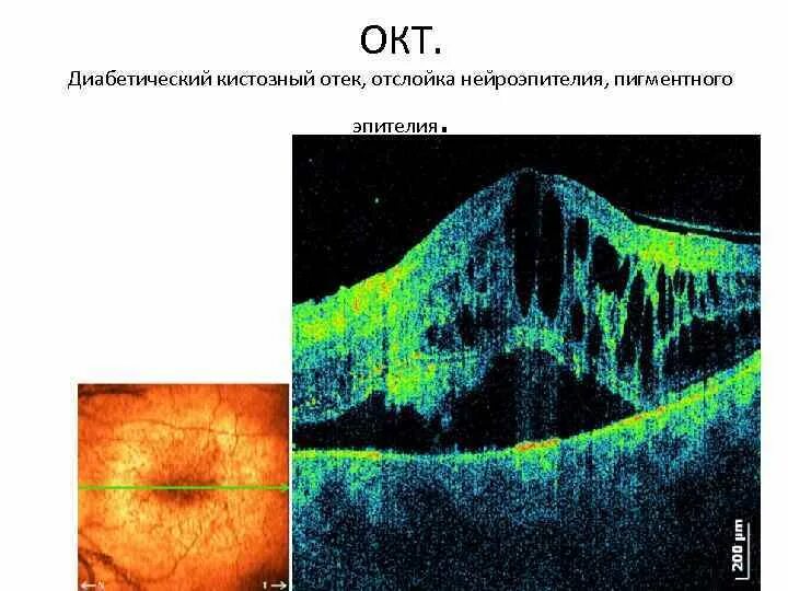 Оптическая когерентная томография норма. Периферическая витреоретинальная дистрофия сетчатки. Когерентная томография сетчатки глаза. Оптическая когерентная томография сетчатки (окт). Окт сетчатки норма расшифровка.