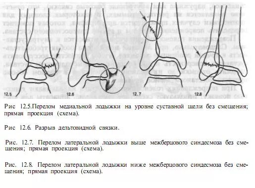 Сколько после перелома
