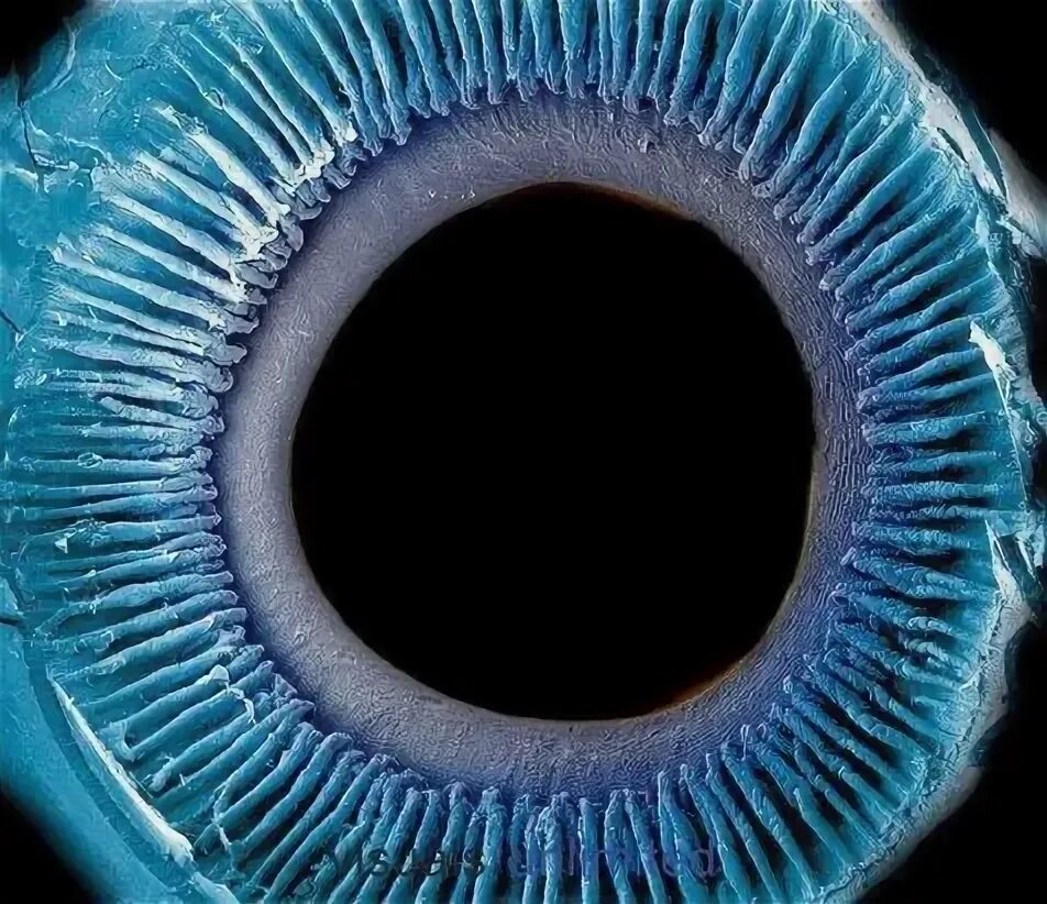 File:Pterygium (conjunctiva).jpg - Wikimedia Commons