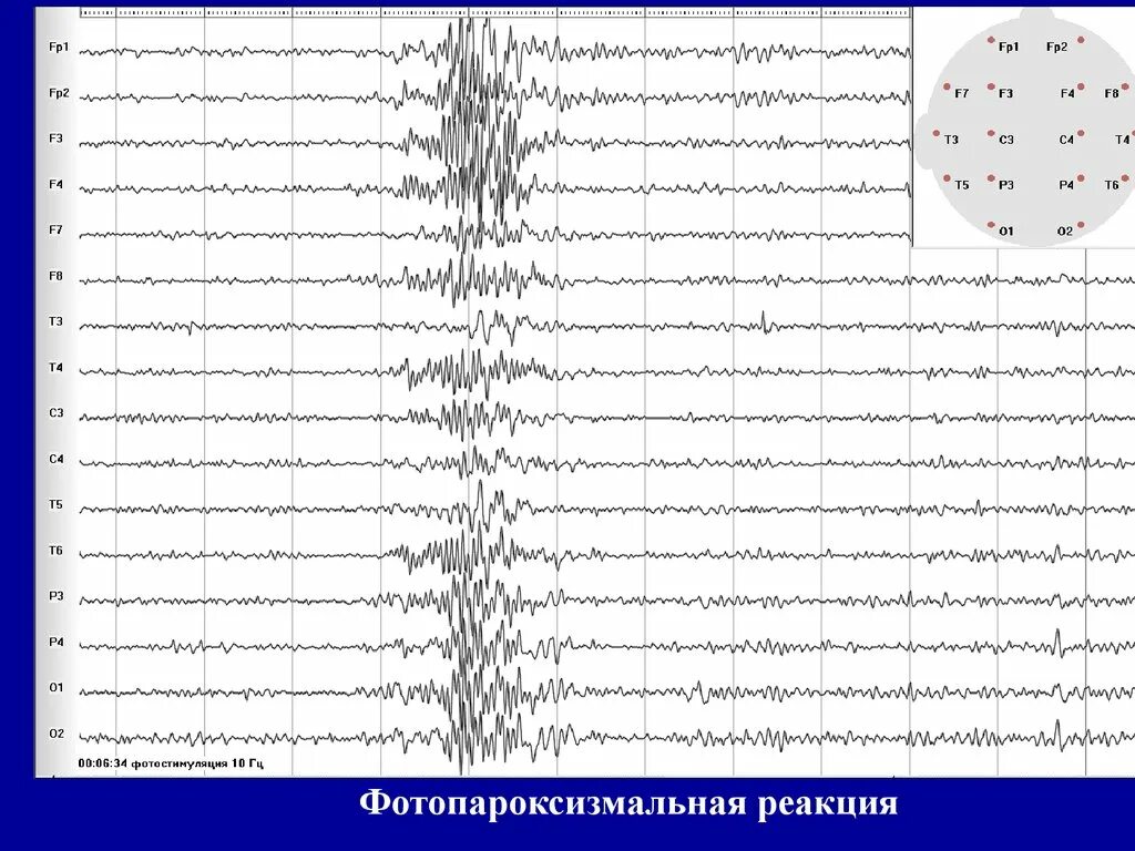 Реакция ээг. Фотопароксизмальная реакция на ЭЭГ. ЭЭГ фотостимуляция норма. ЭЭГ ритмическая фотостимуляция усвоения. Фотомиоклонический ответ на ЭЭГ.