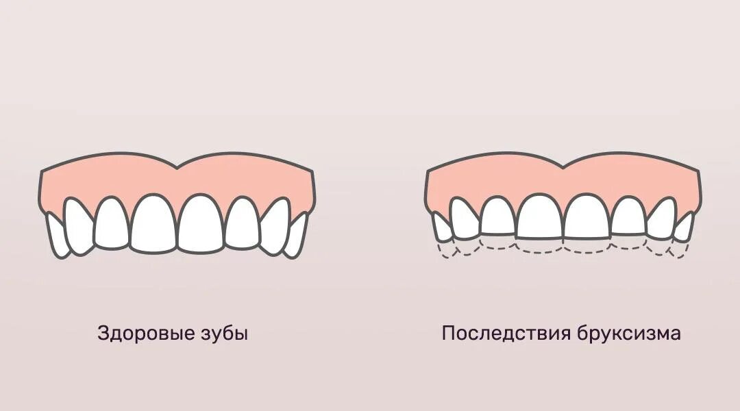 Зубы стучат что значит. Бруксизм скрежетание зубами. Сжатые зубы.