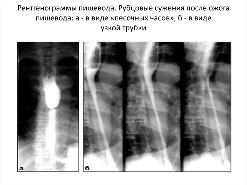 Рубцовые сужения пищевода