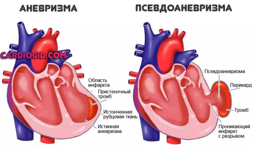 Чем отличается инфаркт от обширного инфаркта