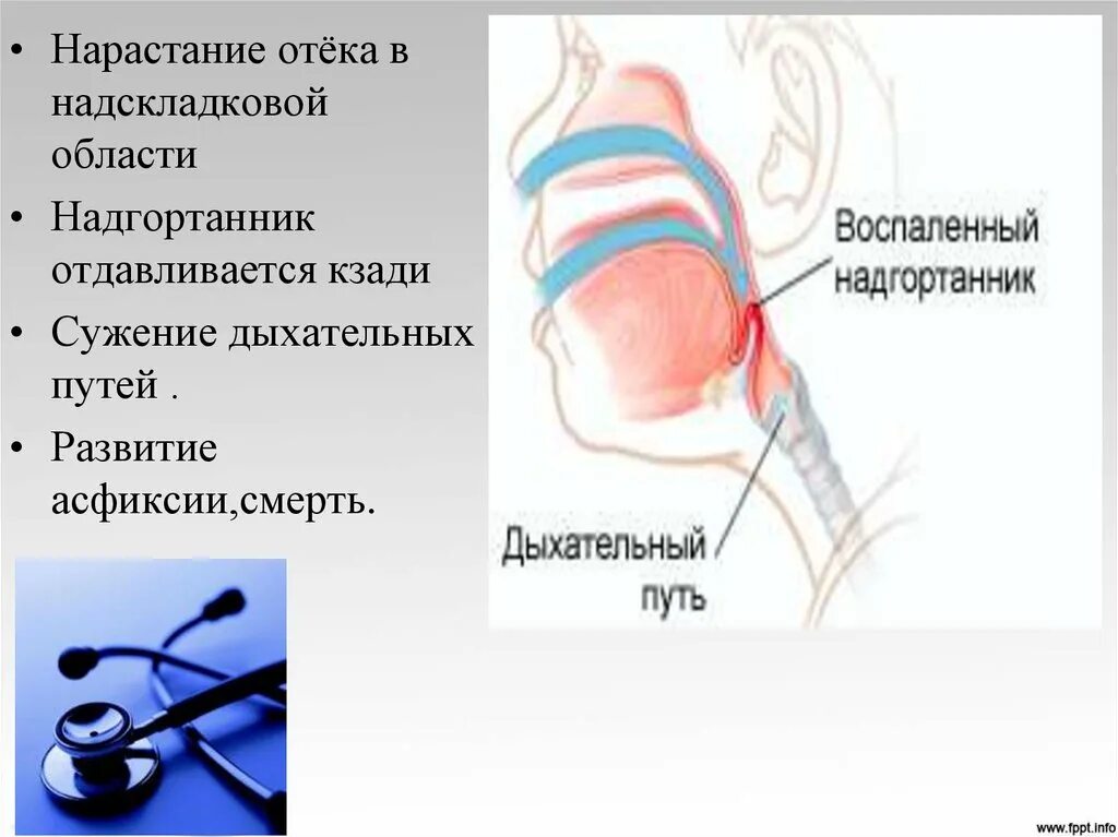 Эпиглоттит симптомы. Эпиглоттит презентация. Стеноз дыхательных путей. Эпиглоттит воспаление надгортанника.