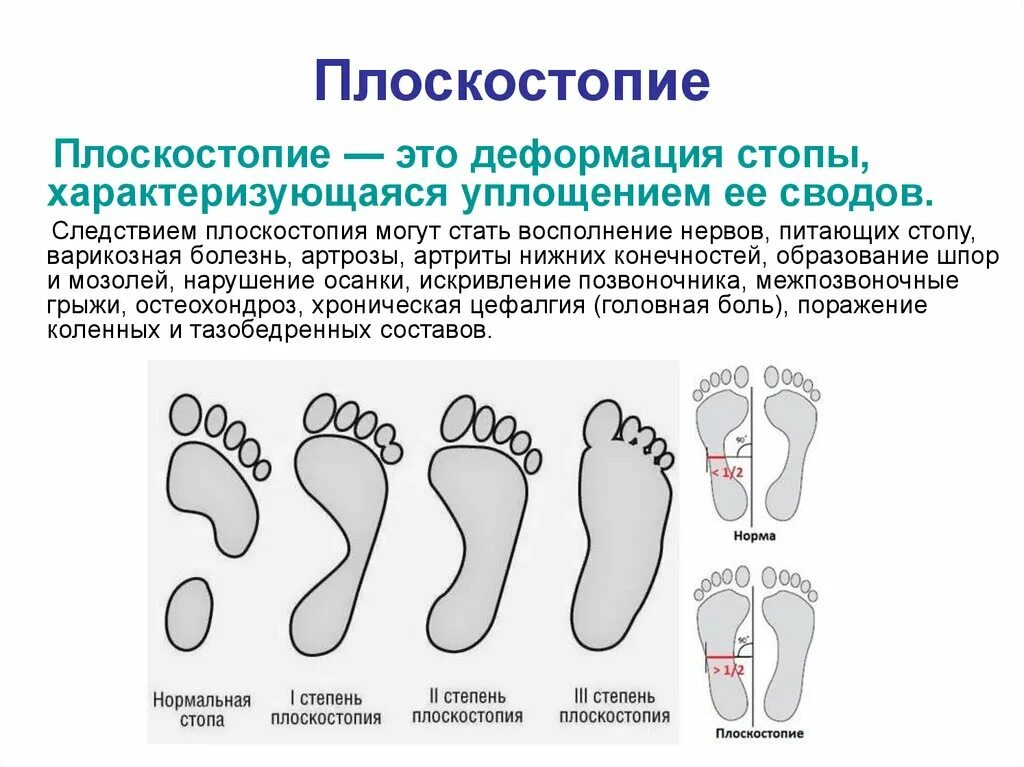 Чем может быть вызвано плоскостопие у человека. Продольно-поперечное плоскостопие 3 степени. Продольное плоскостопие 3 степени. Поперечное плоскостопие 3-4 степени. Степени продольного и поперечного плоскостопия.