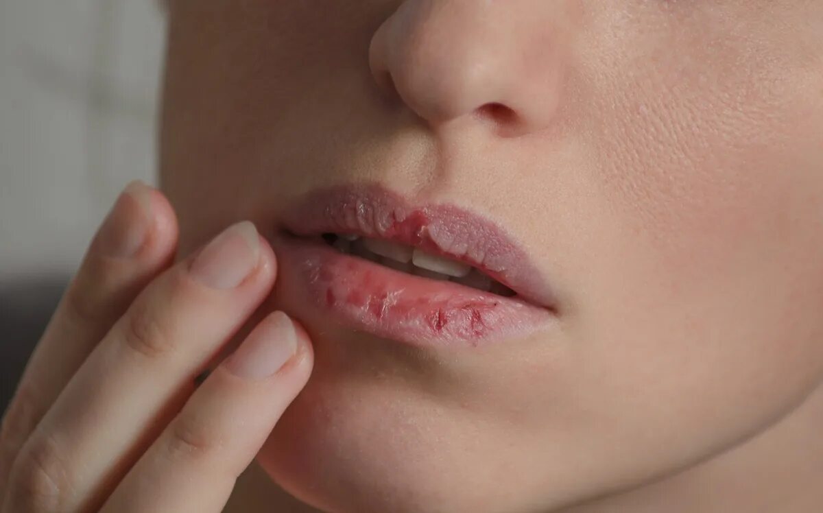 Broken lips