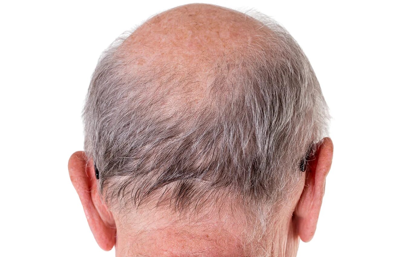 редкие волосы у женщин. седая лысина. стрижки с облысением у мужчин. прическа старика лысина. седая лысина.