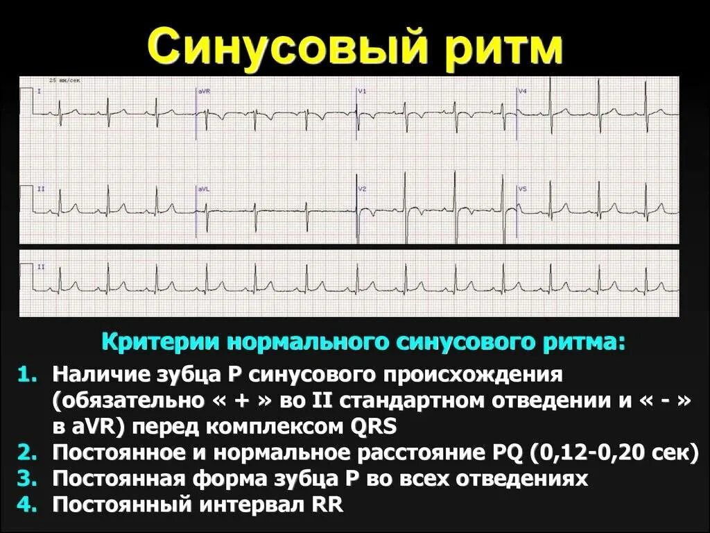 Кардиограмма сердца расшифровка синусовый ритм норма. Правильный синусовый ритм на ЭКГ. Заключение ЭКГ ритм синусовый 90 с. ЭКГ нормальные синусовый ритм норма. Экг метаболические изменения что это значит