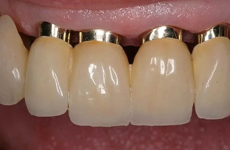 Цельнолитые коронки и штампованные коронки. Железные зубные протезы. Металл керамика коронка. Коронка металлокерамическая (фасетка). Золотая коронка на передний зуб.