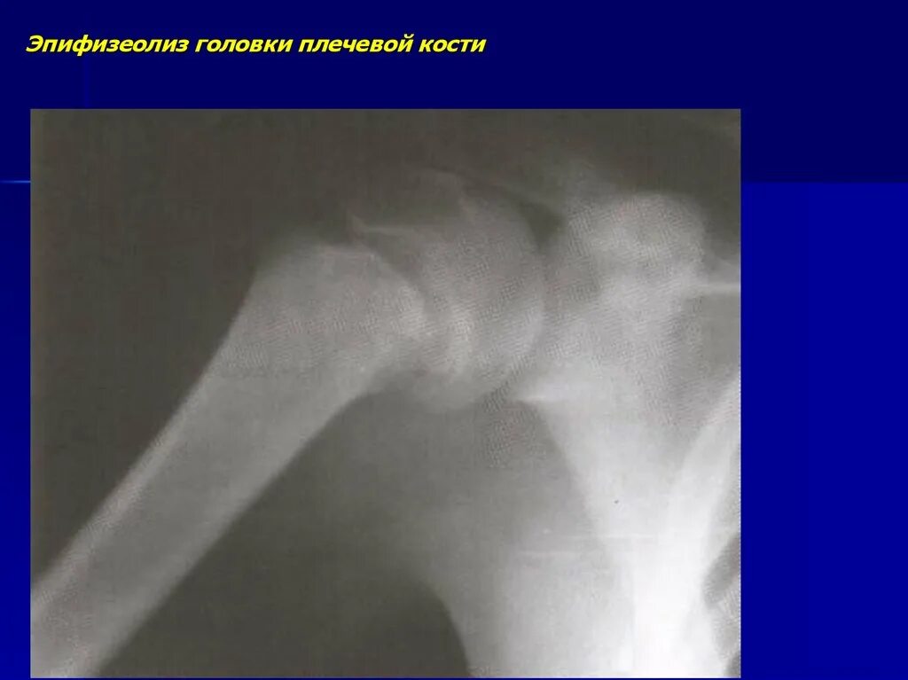 Большой бугорок плечевого сустава перелом