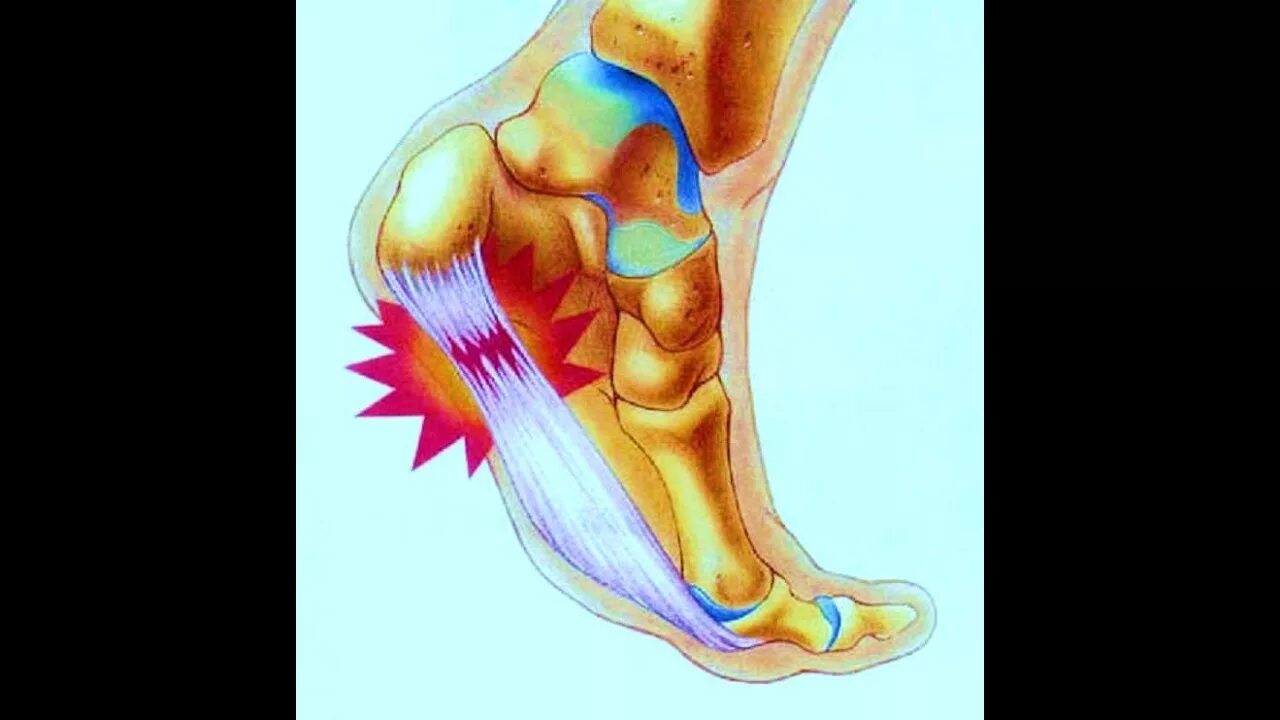 Подошвенный (плантарный) фасциит. Симптомы плантарного фасциита. Можно наступать на пятку
