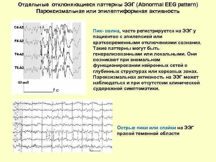 Что значит эпилептиформная активность. Эпилептиформные паттерны на ЭЭГ. Пароксизмальная активность на ЭЭГ У ребенка. Эпи паттерны на ЭЭГ. ЭЭГ эпилепсия пик-волна.