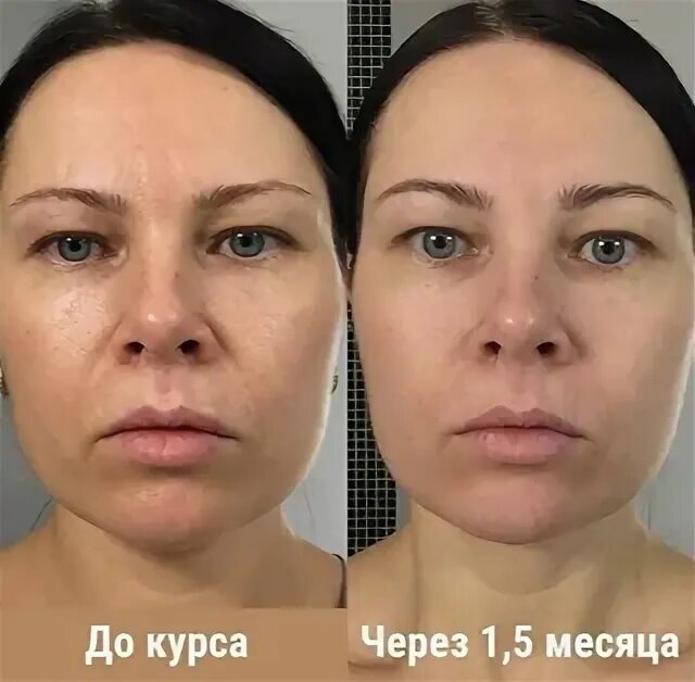 Бурдюг разоблачение до и после пластики. Анастасия бурдюг. анастасия бурдюг до и после. бурдюг до и после. анастасия бурдюг фото до и после.