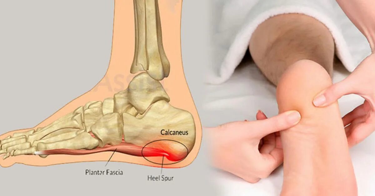 Лечение пяток больно наступать на пятки