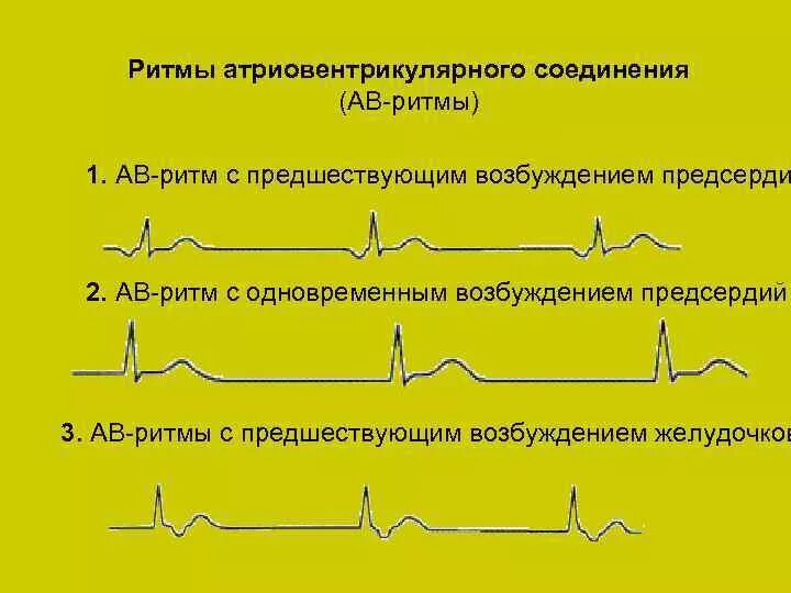 Rhythm ритм. Ритм АВ соединения с предшествующим возбуждением желудочков. Ритм атриовентрикулярного соединения на ЭКГ. Ритм АВ соединения на ЭКГ признаки. Ритм из атриовентрикулярного соединения на ЭКГ.