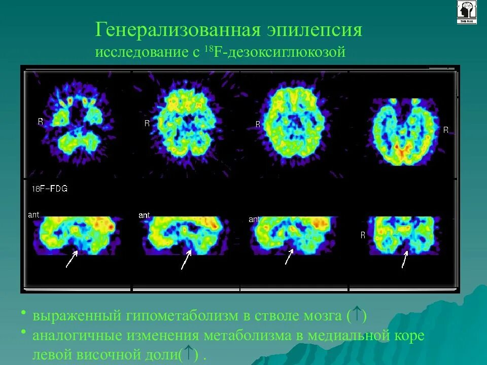 Исследование эпилепсии. ПЭТ эпилепсия. Позитронно-эмиссионная томография. ПЭТ кт эпилепсия. ПЭТ-кт головного мозга при эпилепсии.