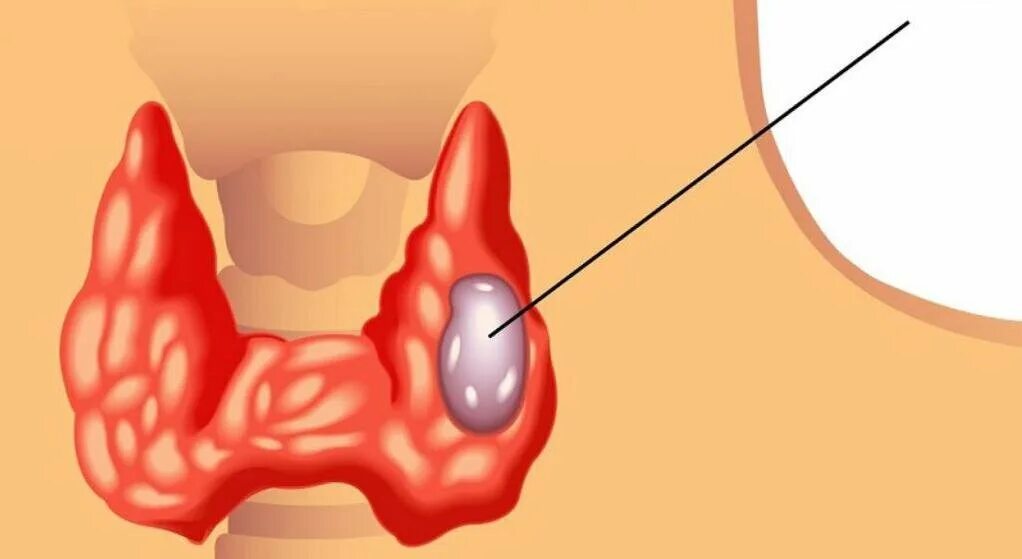 Узловой зоб щитовидной железы. Аденоматозный зоб щитовидной железы. Щитовидная железа зоб узлы. Зоб ахан