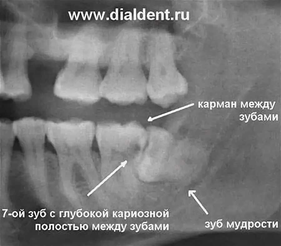 Удалить зубы семерки. Удалить зубы семерки