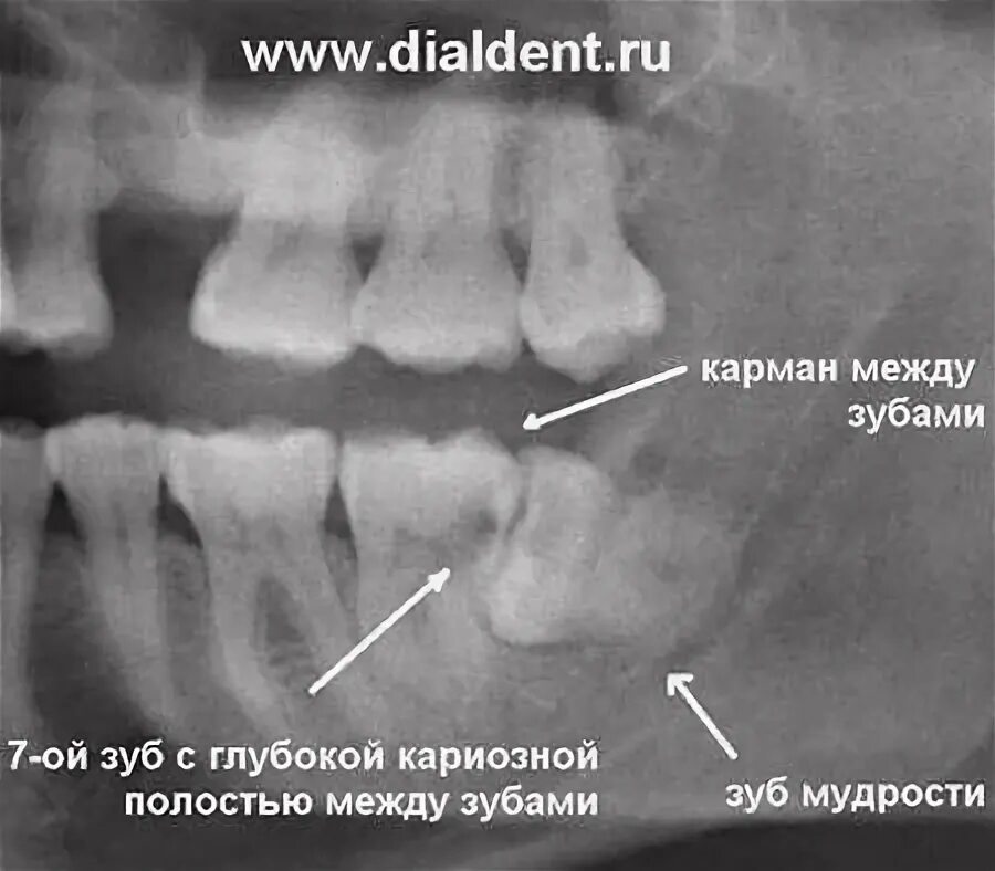 Удаление зуба семерки