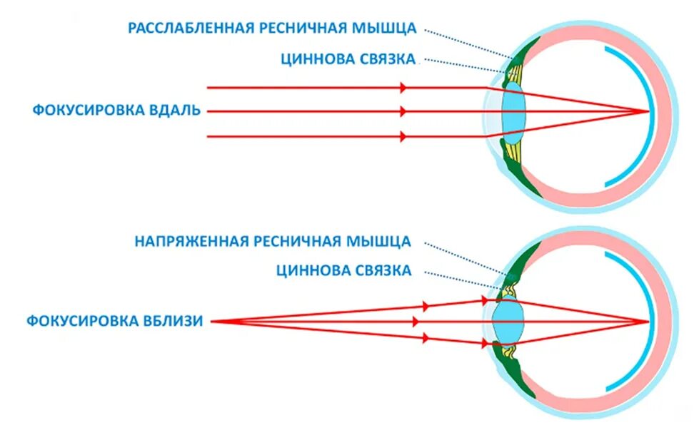 Схема аккомодации хрусталика. Аккомодационный аппарат глаза схема. Спазм аккомодации схема. Механизм аккомодации глаза схема. Лучи света фокусируются за сетчаткой