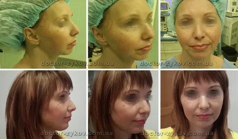 Липофилинг грудных желез до и после