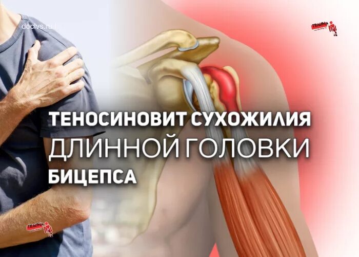 Отрыв сухожилия двуглавой мышцы плеча. Сухожилие бицепса лечение. Тендинит сухожилия двуглавой мышцы. Сухожилие бицепса лечение. Тендинит сухожилия бицепса плечевого.