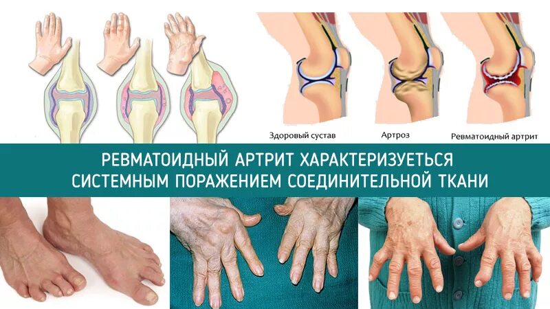 Ревматизм ног