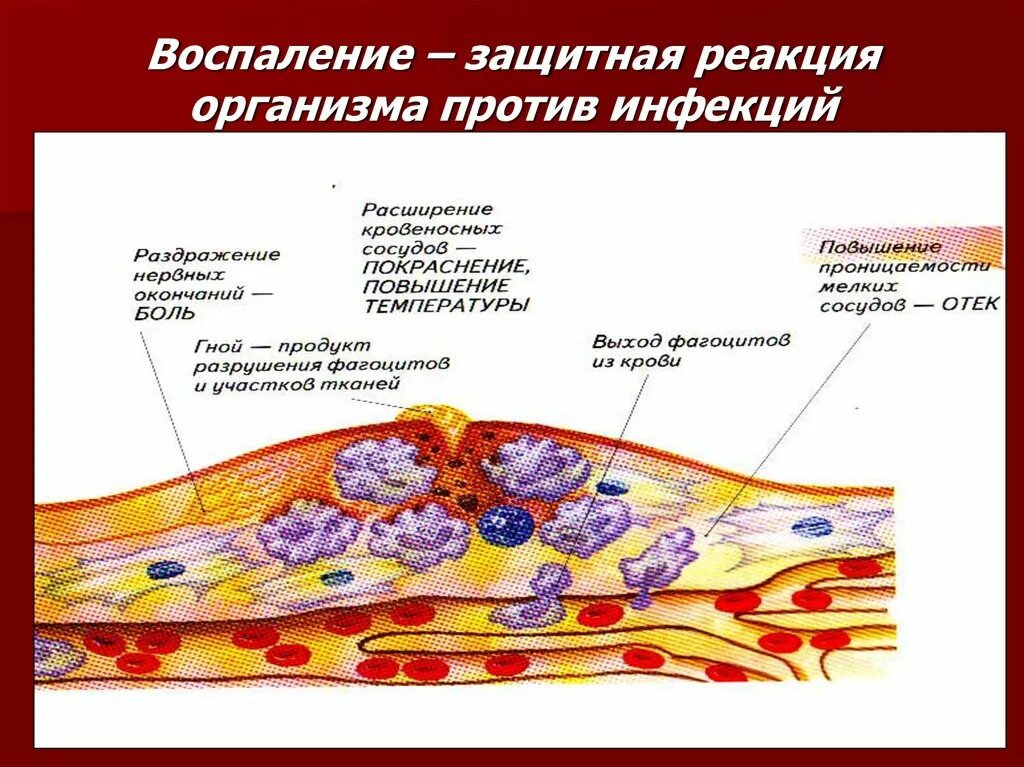 Воспалительная реакция и воспалительный процесс. Воспалительный процесс рисунок. Схема воспалительного процесса. Нейровоспалительный процесс. Реакция организма клетки на