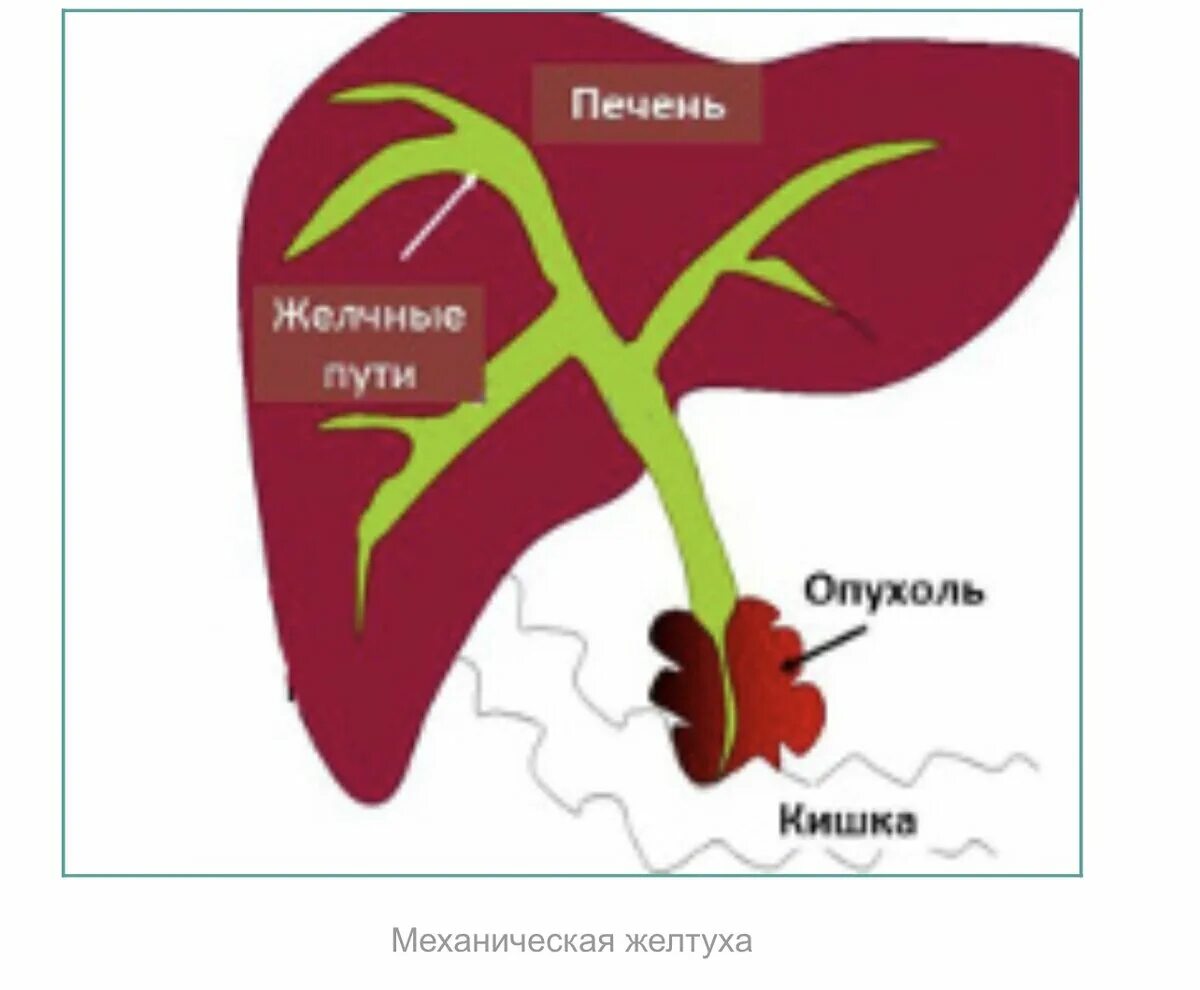 Увеличенный желчный пузырь причины