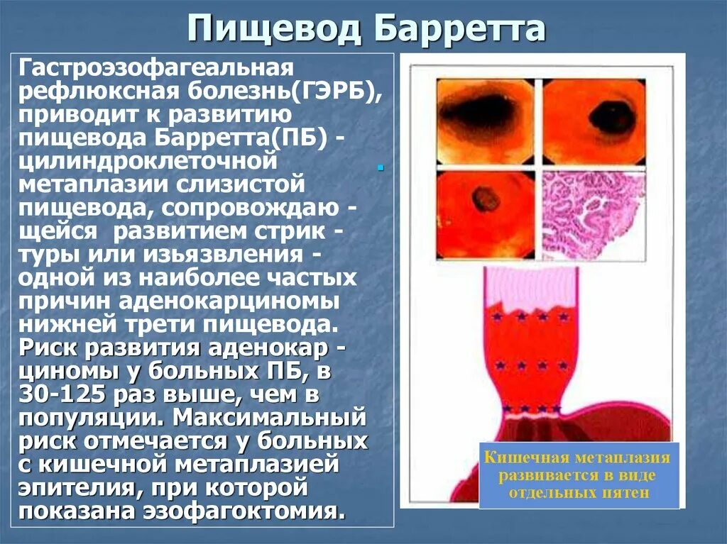 Желудочная цилиндроклеточная метаплазия пищевода. Толстокишечная метаплазия пищевода Барретта. Гастроэзофагеальная рефлюксная болезнь патанатомия. Метаплазия эпителия пищевода.