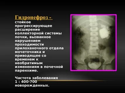 Тесты гидронефроз по утвержденным клиническим рекомендациям 2023