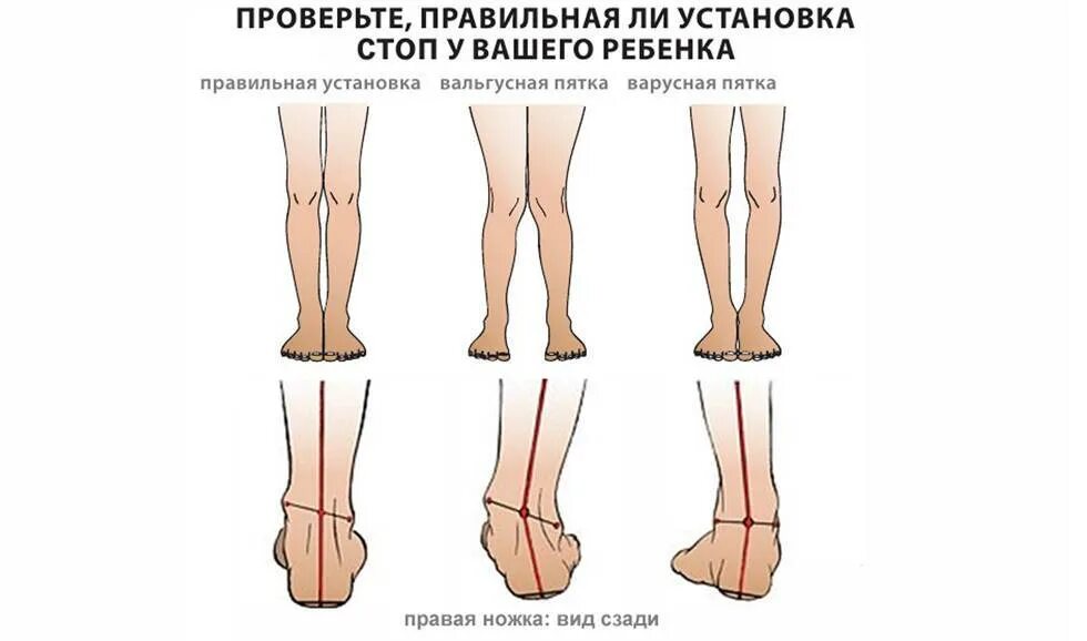 Правильные стопы ног. Вальгусная и варусная деформация стопы. варусная деформация стопы рентген. вальгус деформация стопы. варусная деформация стопы.