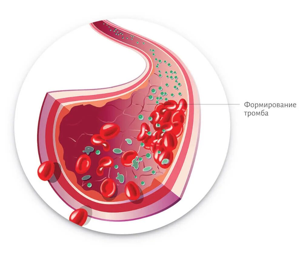 Кровяной тромб