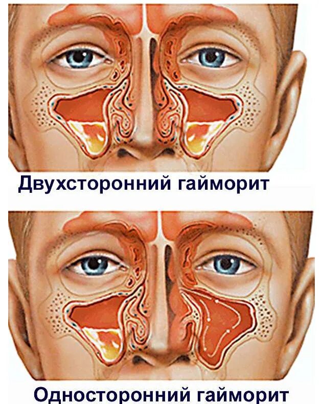 Пазухи носа гайморит синусит. Гайморова фронтит синусит. Синусит, ринит, гайморит у ребенка. Признаки заложенности носа