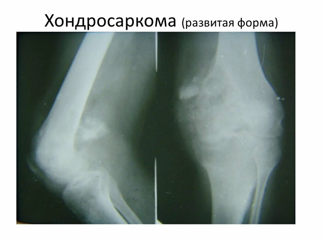 Хондросаркома плечевой кости рентген. Хондросаркома плечевой кости на кт. Хондросаркома бедренной. Хондросаркома кости рентген. Хондросаркома плечевой кости.