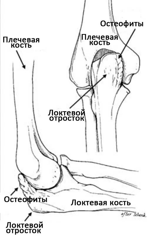 Локтевого мыщелка. Мыщелки локтевого сустава. Венечный отросток локтевого сустава. Плечевая кость локтевой сустав. Венечный отросток локтевой кости.