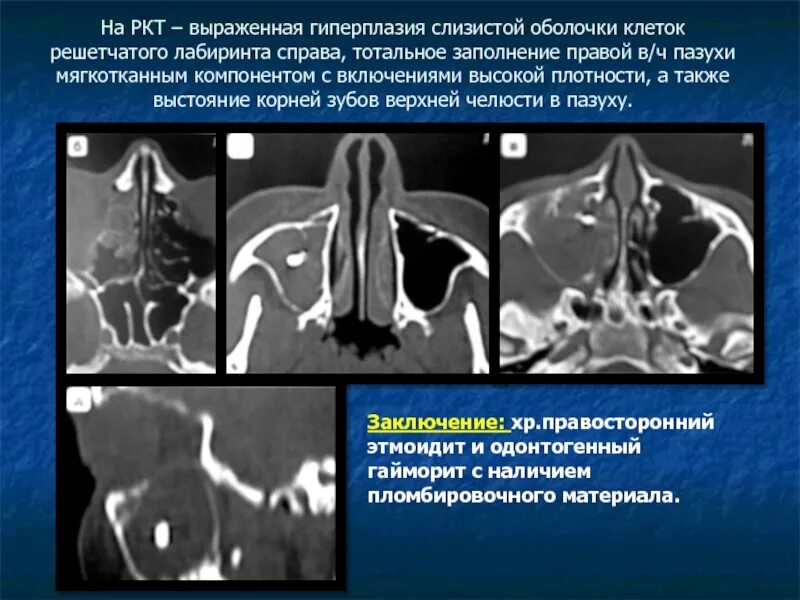 Анатомия клеток решетчатого Лабиринта на кт. Анатомия пазух носа на кт. Клетки решетчатого Лабиринта на кт. Утолщение слизистой решетчатого Лабиринта.