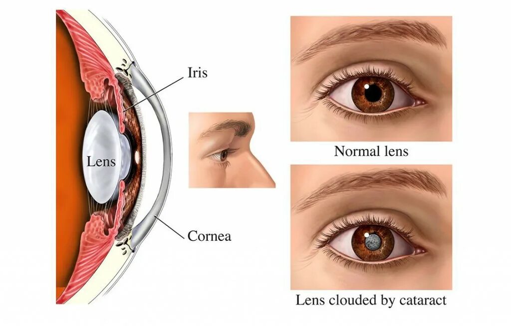 Катаракта операция в спб. Капсулярная катаракта. Катаракта торическая линза.