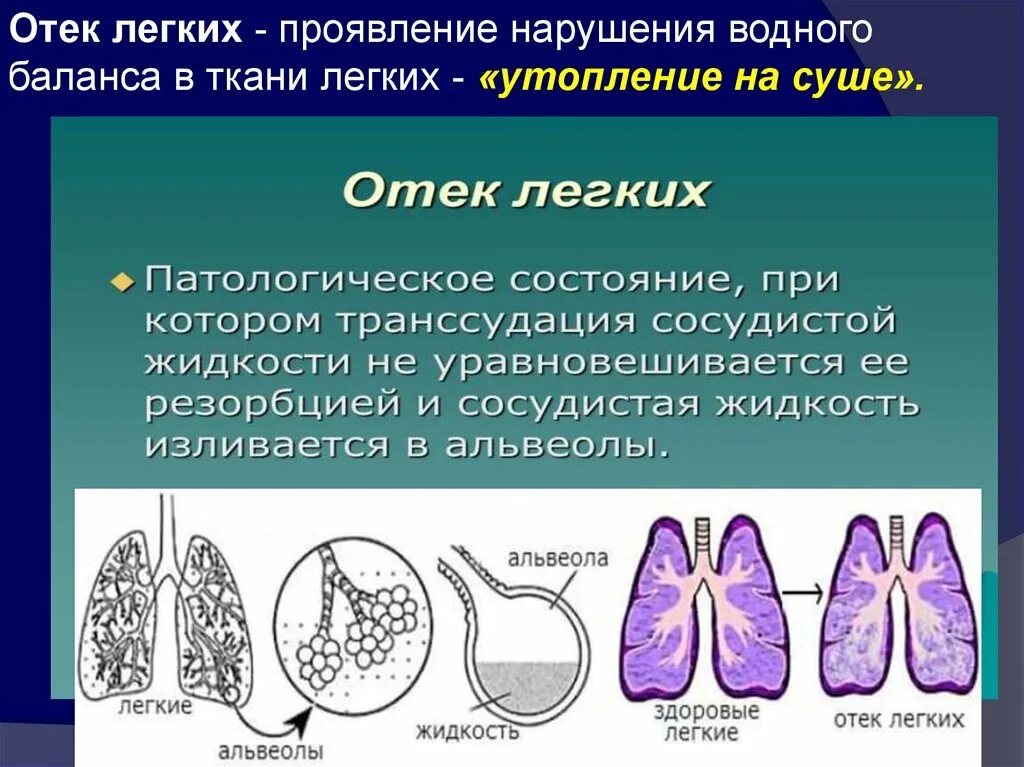 Отек легких жидкость. Отек легкого презентация. Отек легких проявления.