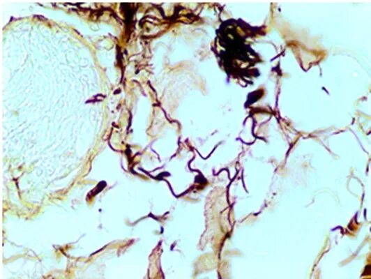 Лептотрикс лечение. Грибы кандида лептотрикс. Нити лептотрикса. Leptothrix ochracea под микроскопом. Железобактерии Leptothrix ochracea.