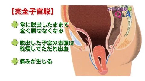 子 宮 脱 イ ラ ス ト.