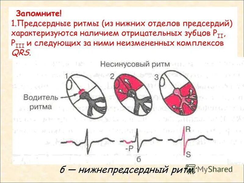 Эктопический предсердный ритм что это. ЭКГ при предсердном ритме. Нижнепредсердный ритм на ЭКГ. Критерии предсердного ритма на ЭКГ. Правопредсердный ритм ускоренный.