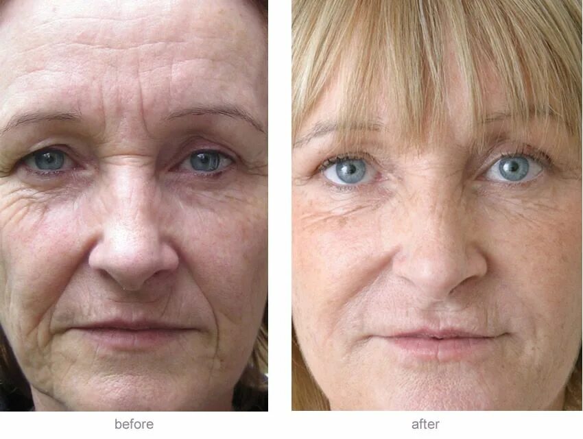 Подтяжка после 60. Ботокс для лица до и после. Контурная пластика лица. Морщины до после. Филлеры до и после.