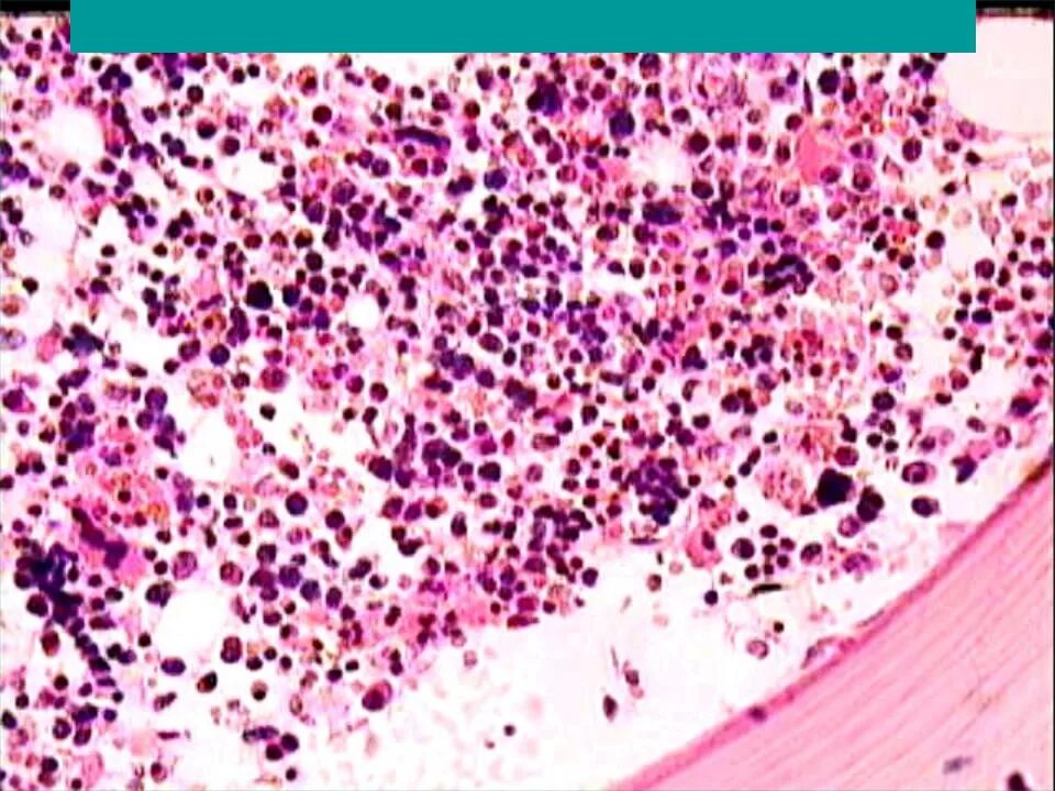 Мозг при остром лейкозе. Острый лимфобластный лейкоз гистология. Миелоидный лейкоз гистология. Острый недифференцированный лейкоз костный мозг. Острый миелобластный лейкоз гистология.